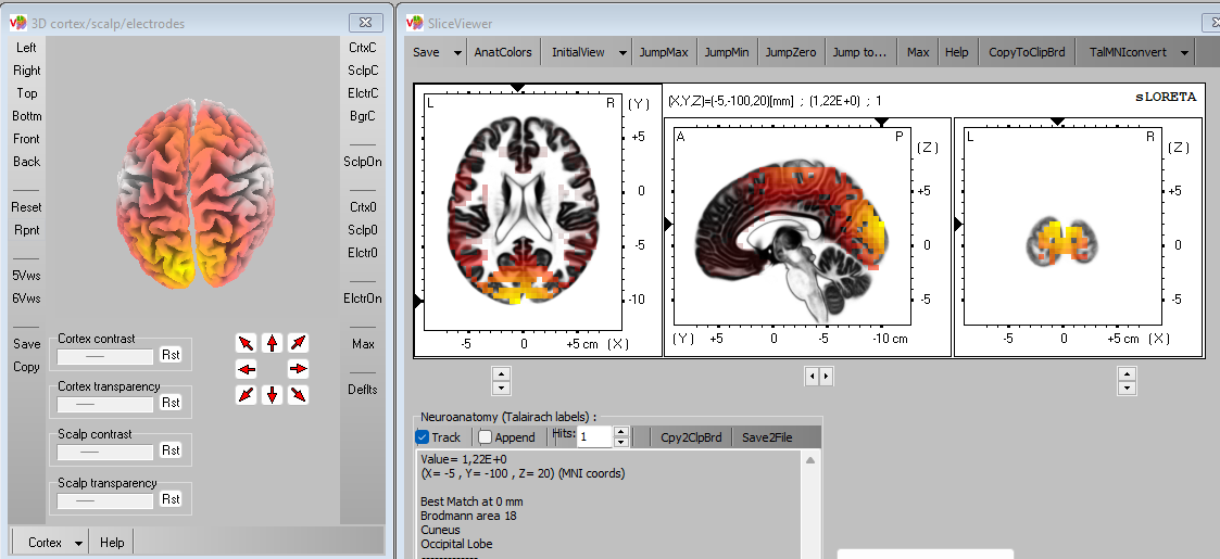 Interfaz de análisis sLORETA con una visualización tridimensional y tres cortes cerebrales de actividad estimada.